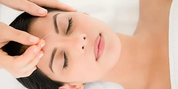 Τι είναι ο αισθητικός βελονισμός προσώπου και ποια τα οφέλη